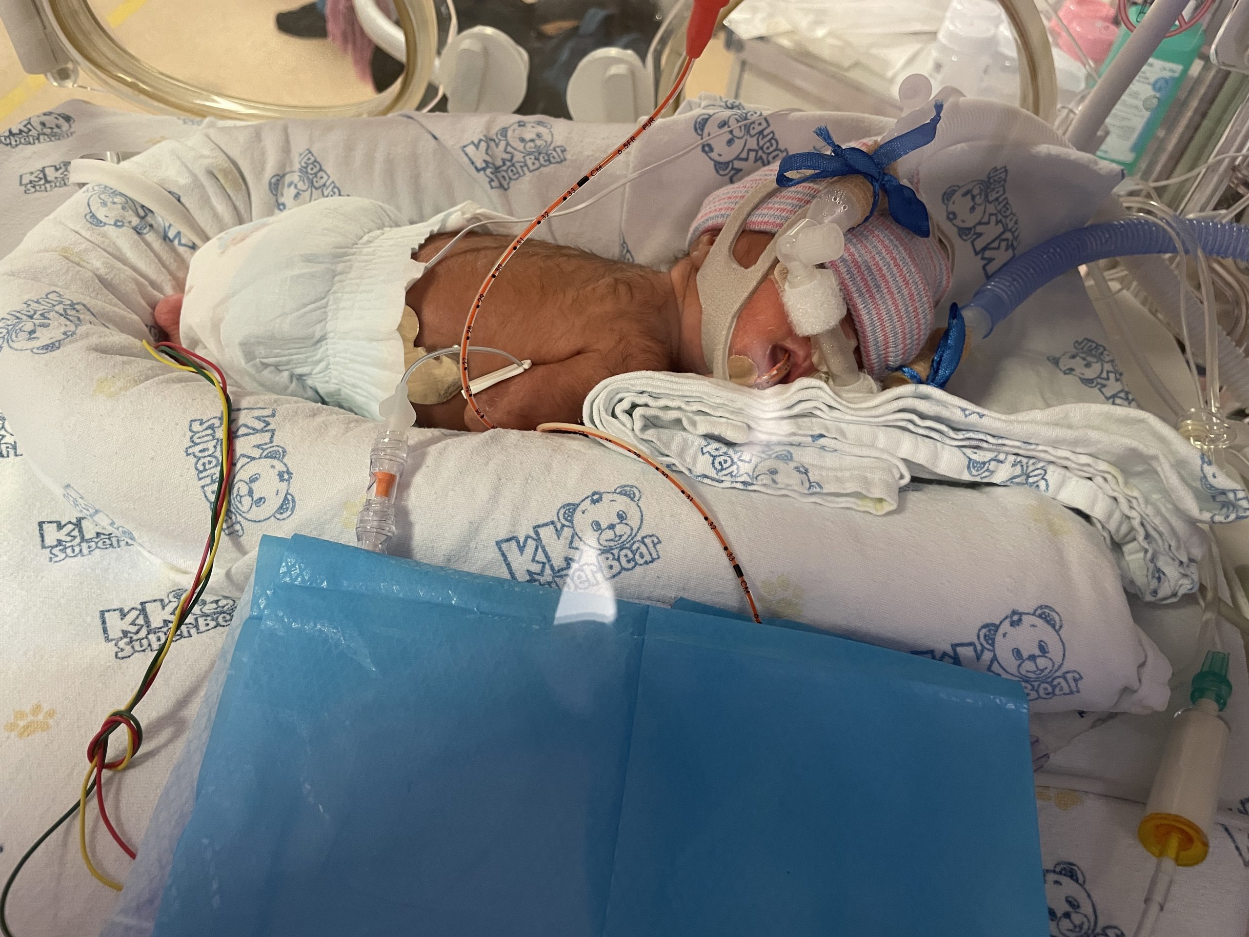 Help Filipino Mom Working in Singapore: Fighting to Save Baby Kassie Born at 27 Weeks